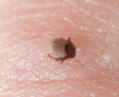 Tick in skin